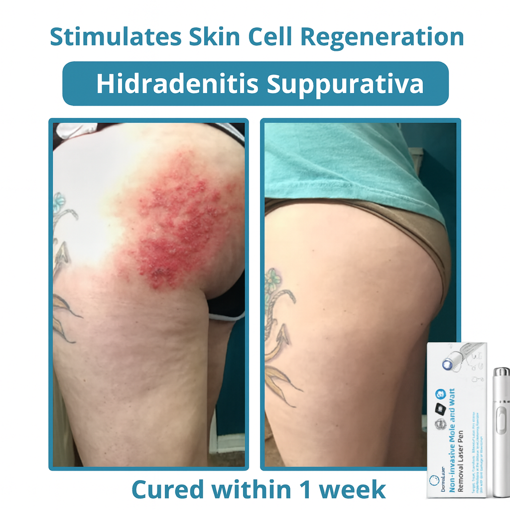 2x DermaLase™